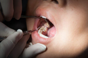 patient getting dental sealants 