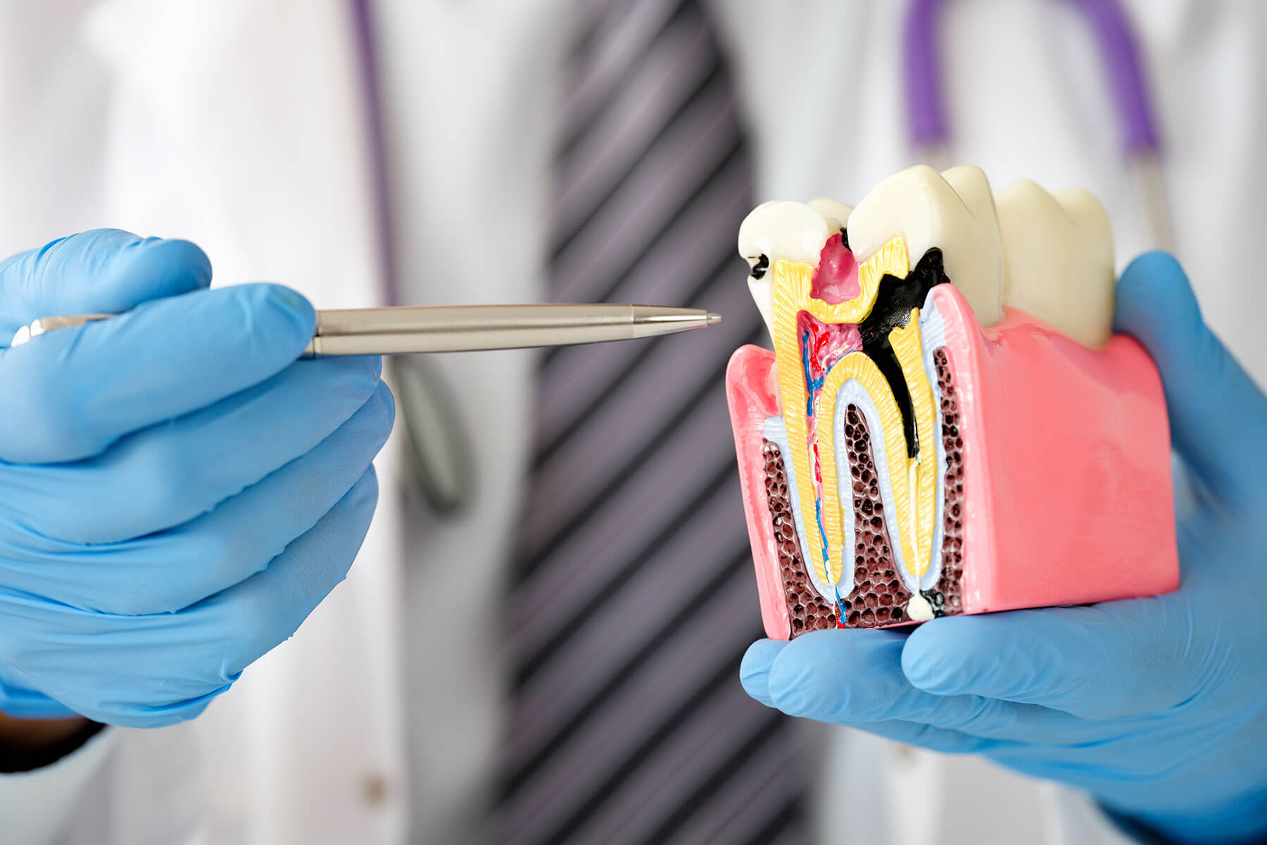 5 Signs You May Have Cavities a doctor wearing gloves points at model of a tooth that has cavities