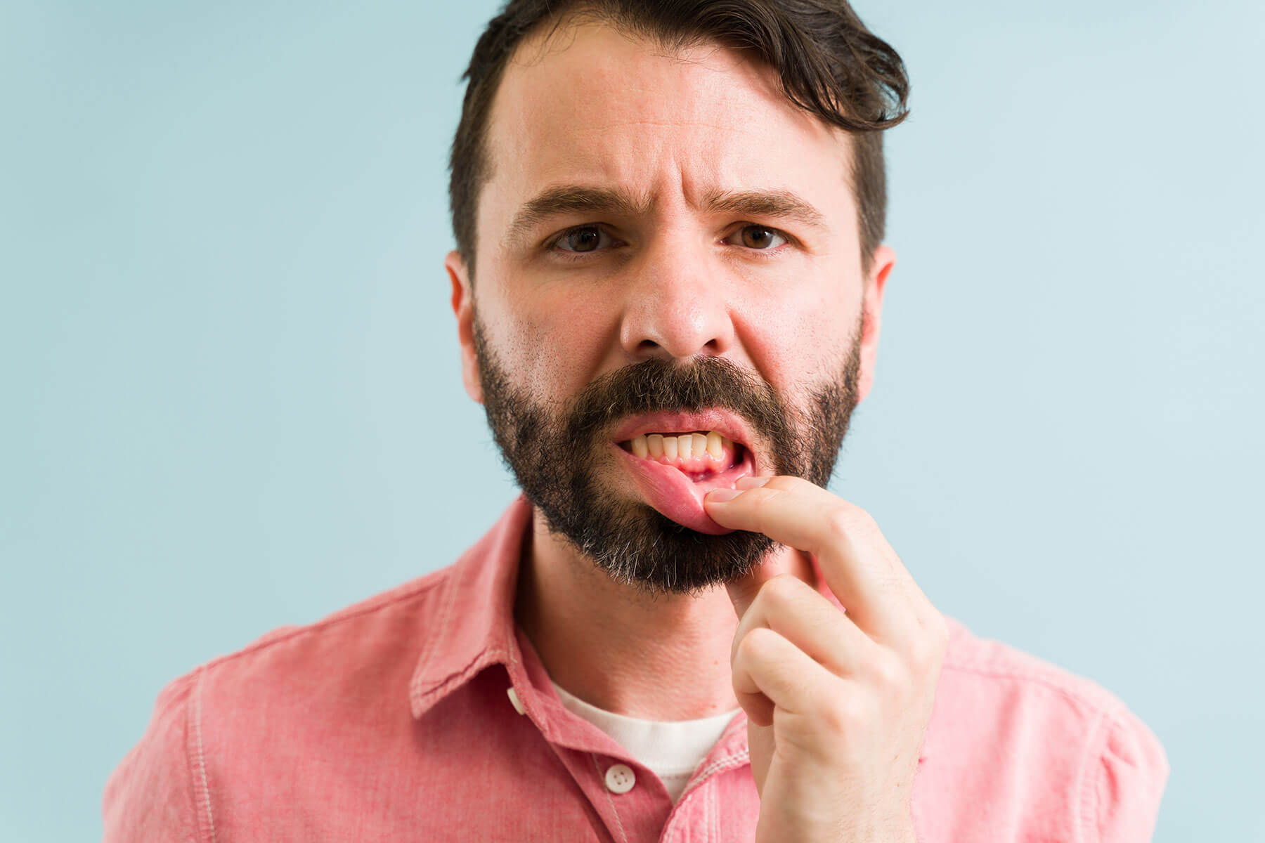 a bearded man in a red shirt pulls down his bottom lip with his hand to expose his gum disease