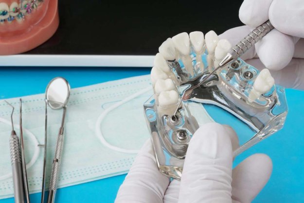 Pros and Cons of Dental Implants a dentist works on dental implants while explaining the pros and cons of dental implants