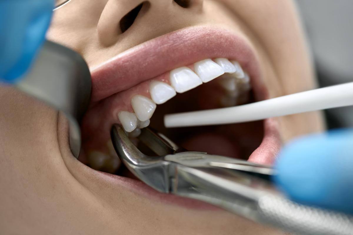 How Much Does It Cost To Remove A Teeth