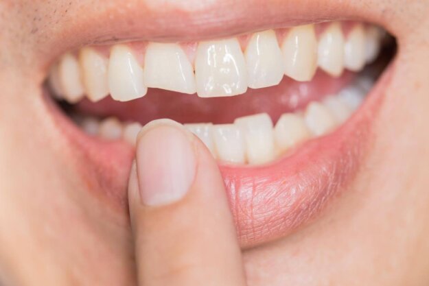The Importance of Repairing Cracked Teeth person points at their cracked tooth while wondering where to go for repairing cracked teeth