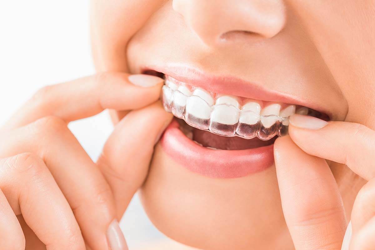 How Much Does Invisalign Cost? Houston Clear Aligners
