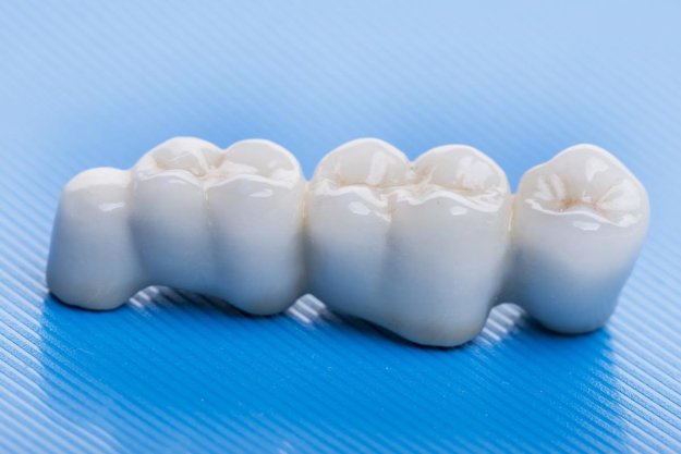 image of crowns to get an idea of the cost of dental crowns
