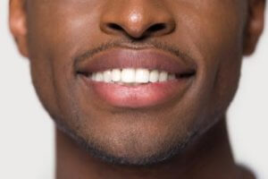 Porcelain Veneers