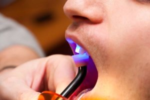 a dentist holding UV light to complete dental bonding in the patient's mouth