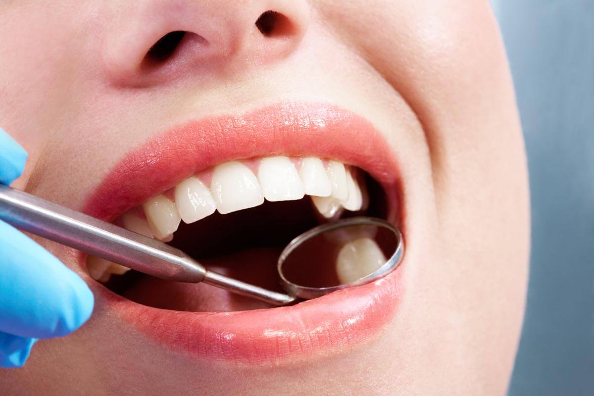 10 Different Types of Dental Fillings | Cavity Fillings in Houston, Texas
