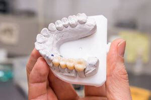 a person holds a molding of a mouth that has dental crowns