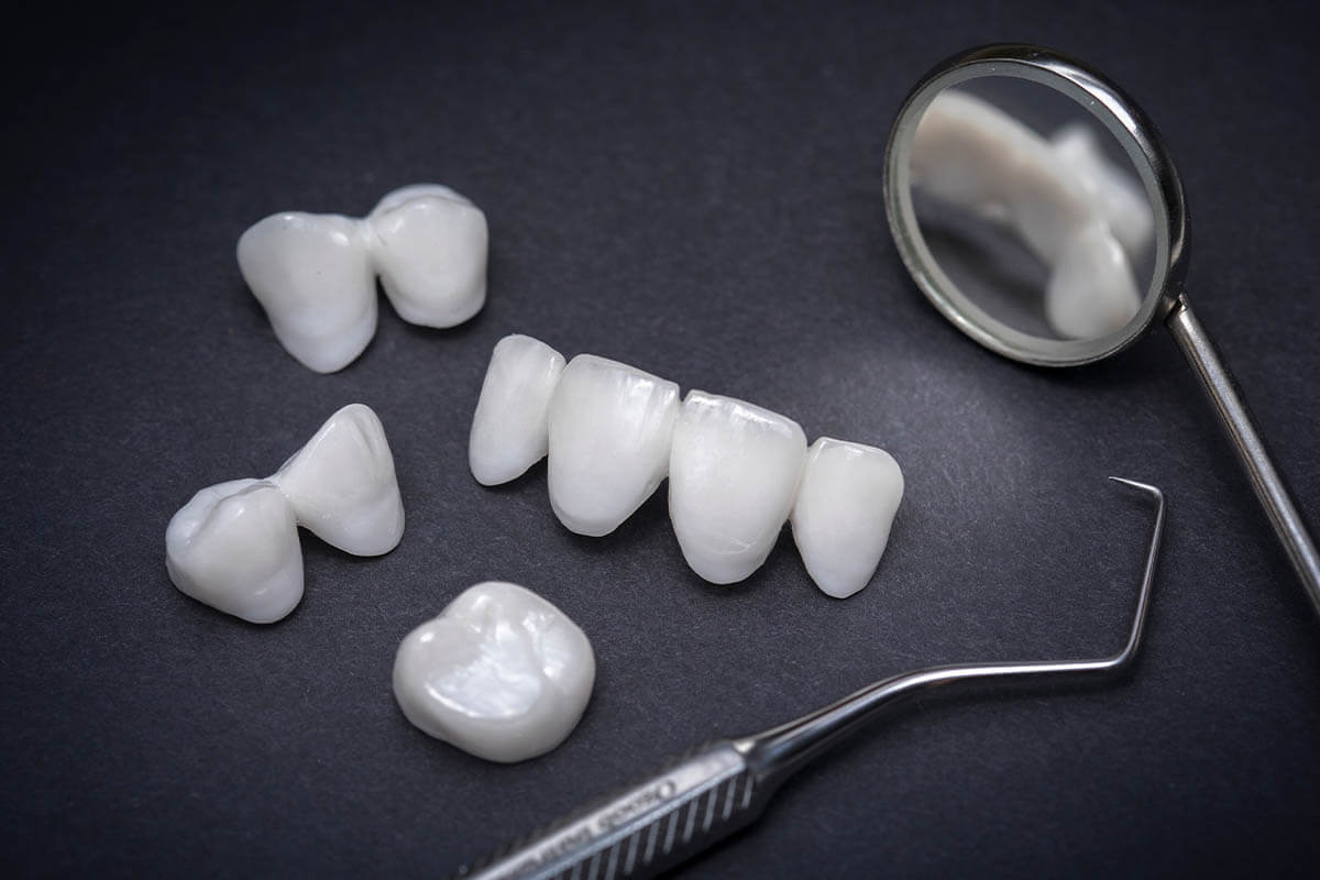 How Long Do Veneers Last? Houston Dental Services