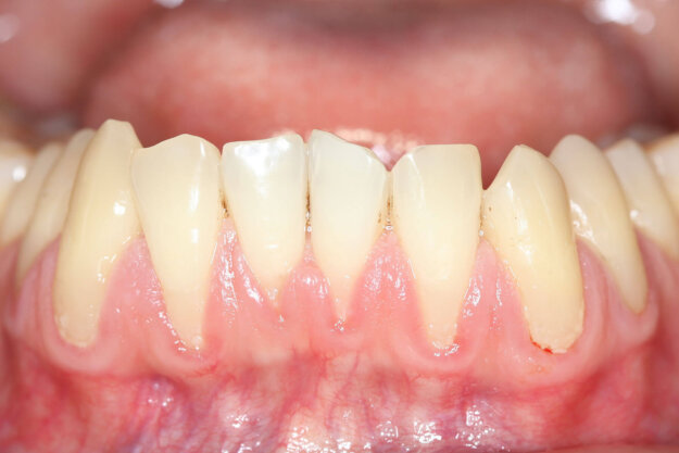 15 Foods to Avoid with Receding Gums photo of a patients receding gums while they listen to their dentist about foods to avoid with receding gums