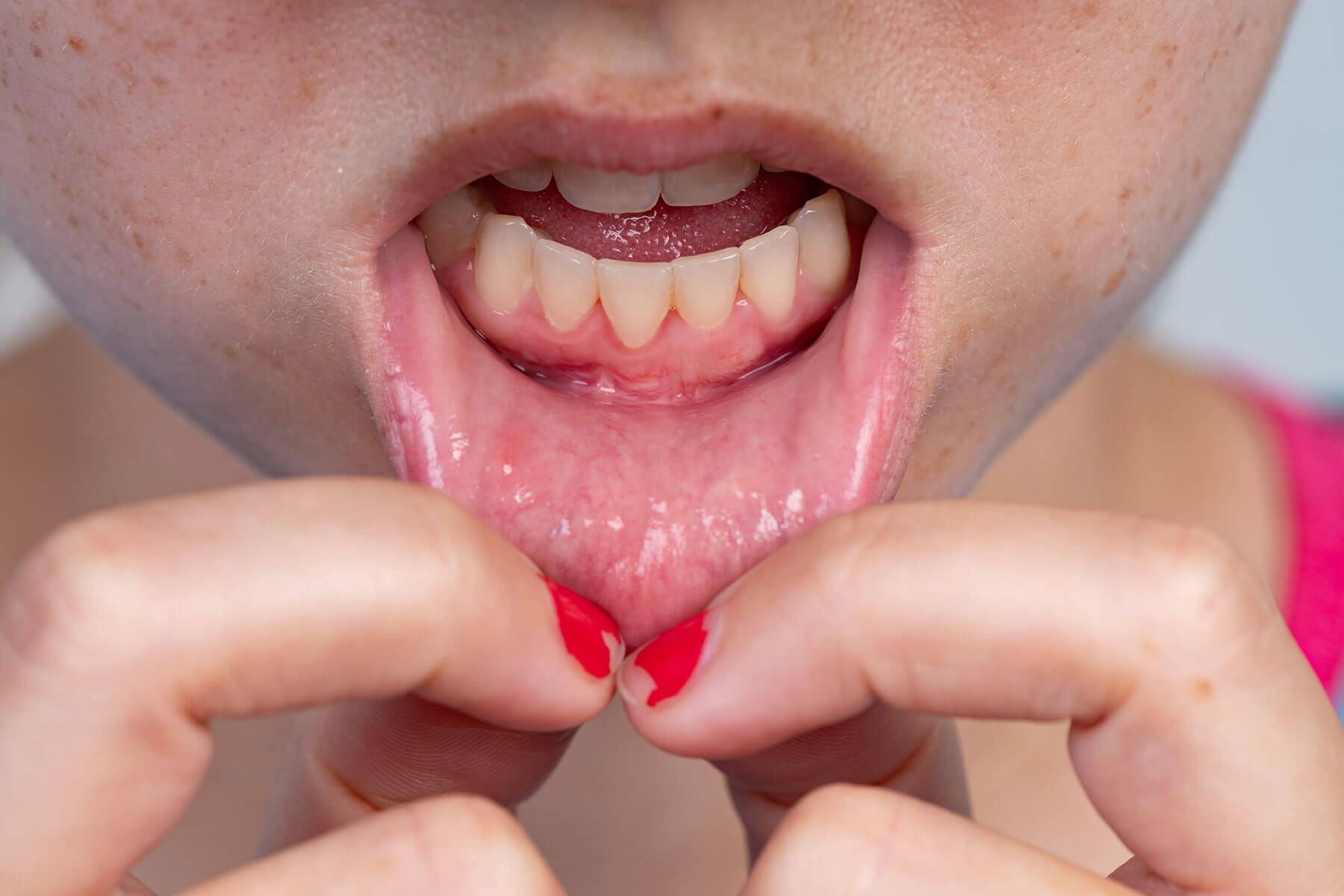 patient holds their bottom lip and shows dentist their receding gums while asking how to reverse gum recession