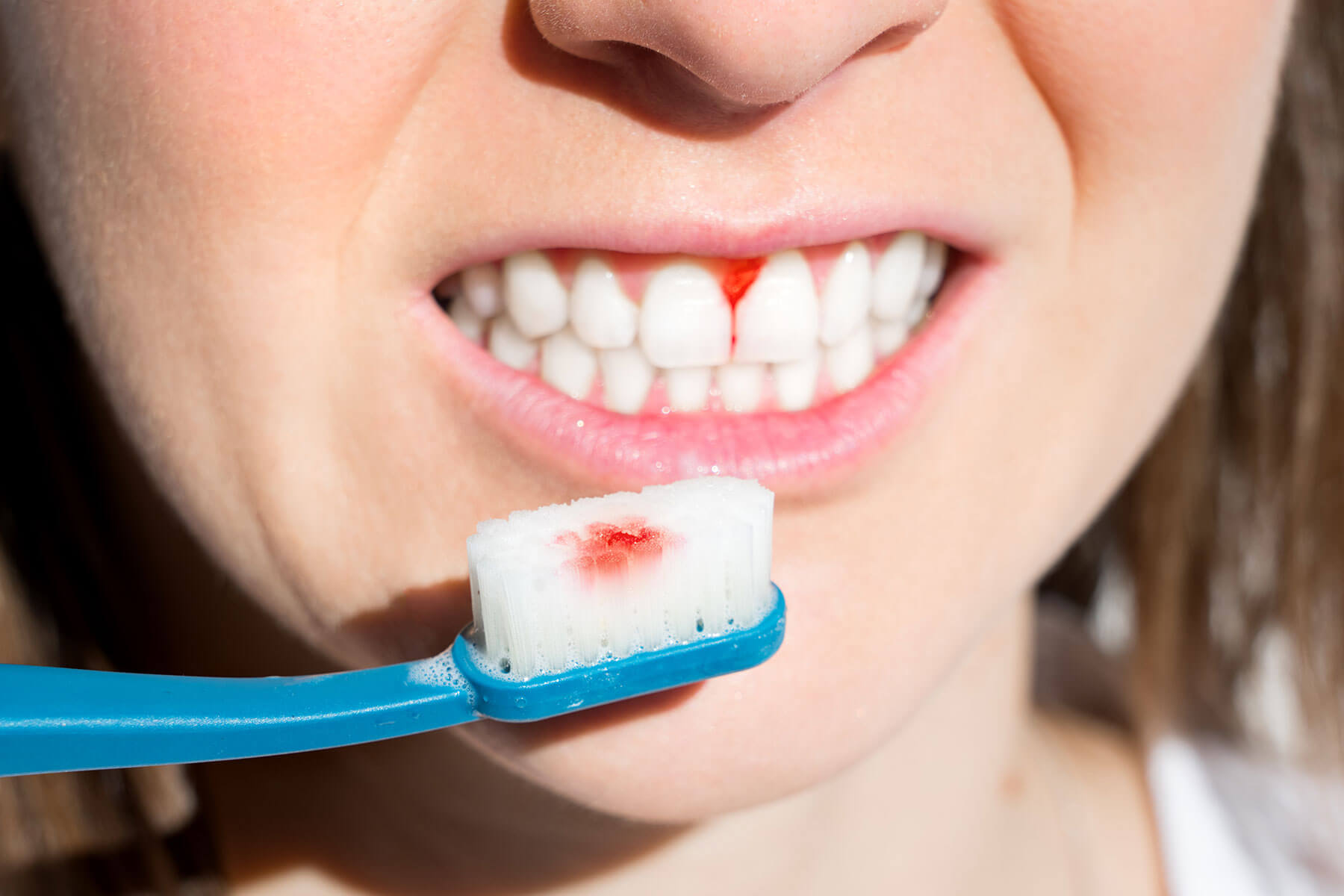 persons gums are bleeding and blood on their toothbrush as they wonder how to stop gum bleeding immediately