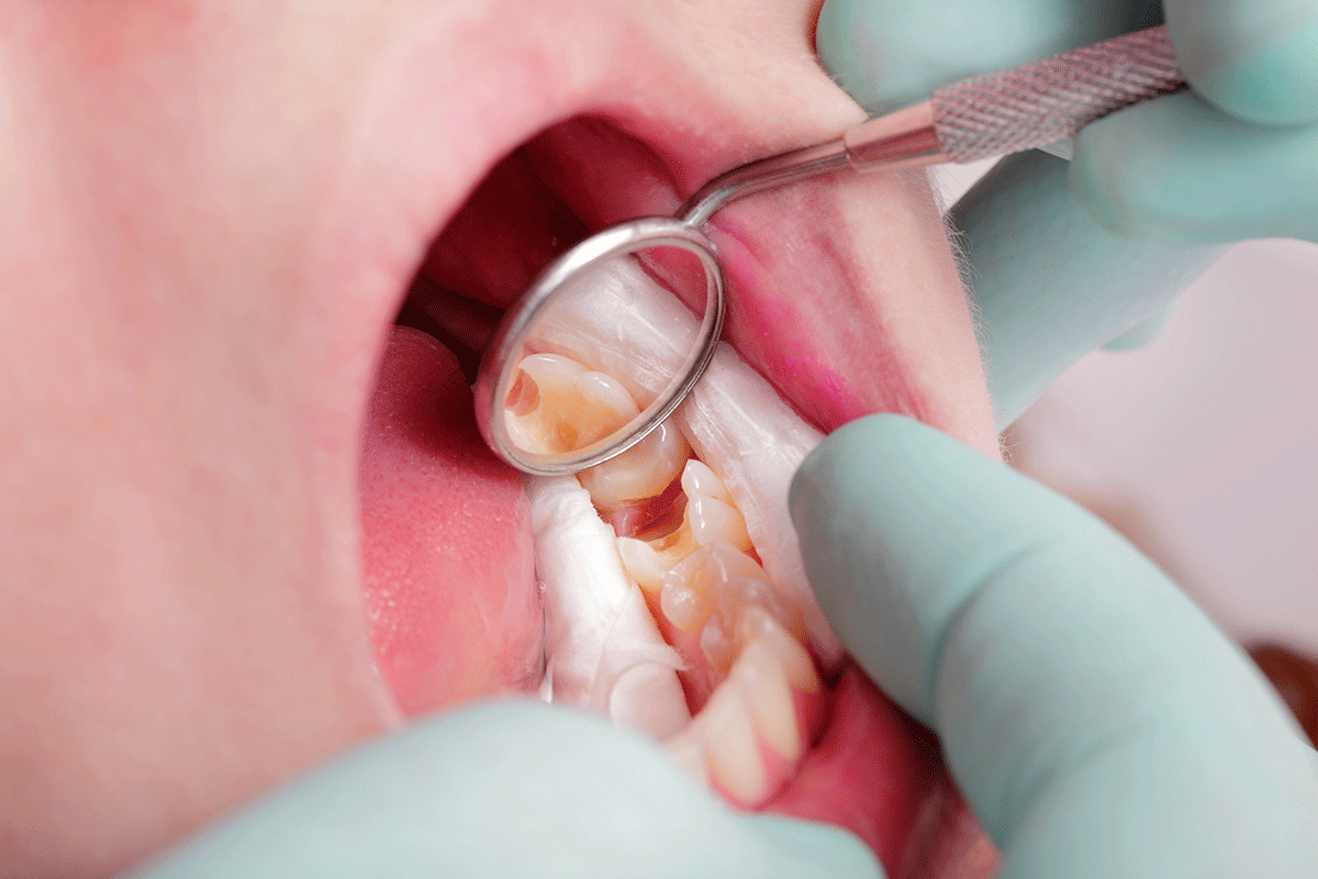 What-Is-a-Cavity-and-What-Does-It-Look-Like a dentist examines a patients mouth and answers the patient question what does a cavity look like