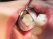 a mirror is used to closely examine a dental patients teeth